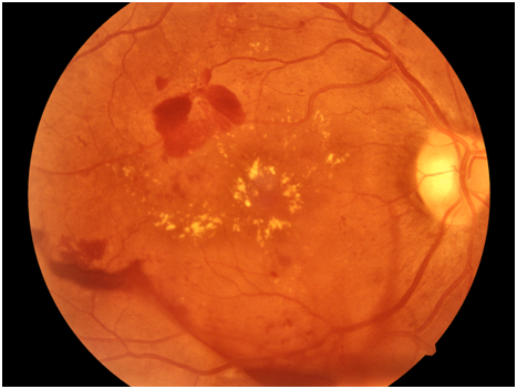 不同程度的眼底病变,排在首位的是糖尿病,高血压眼底改变,如硬性渗出